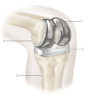 Image result for knee transplant