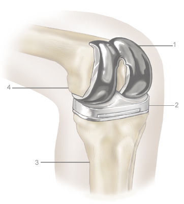 The Cost of Total Knee Replacement