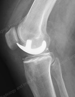 partial knee replacement